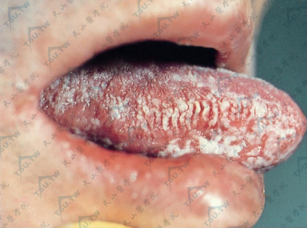 口腔毛状黏膜白斑