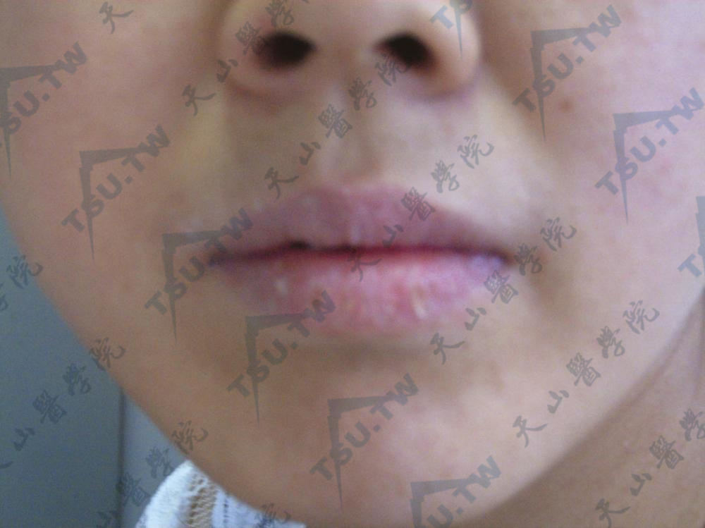 月经疹症状：每次月经前口唇发红、肿胀，表皮剥脱