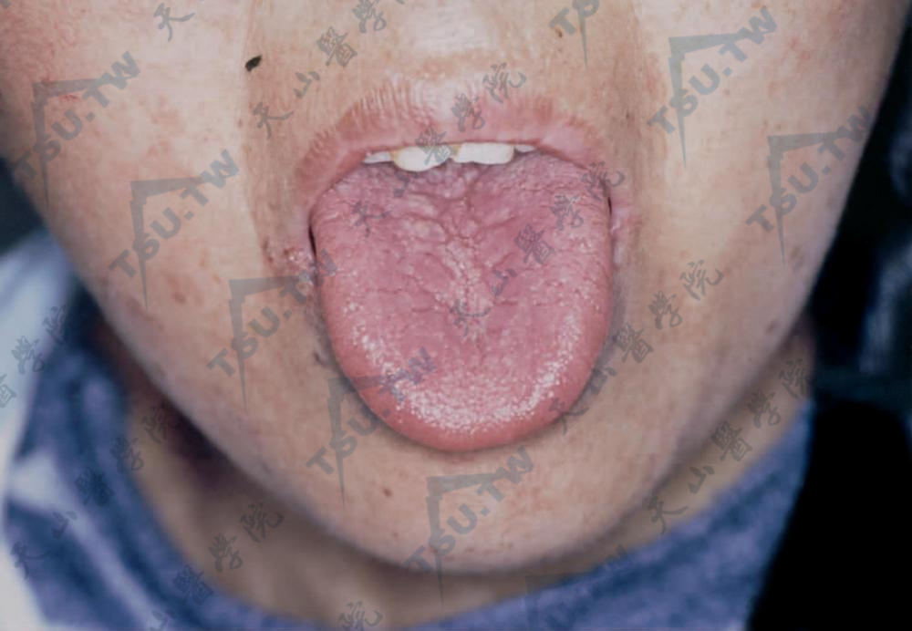 胰高血糖素瘤综合征舌头病变