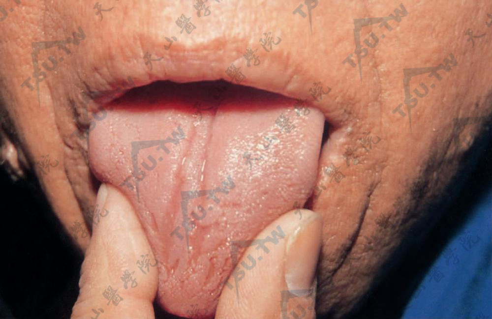黑棘皮病（黑角化病）舌头病变