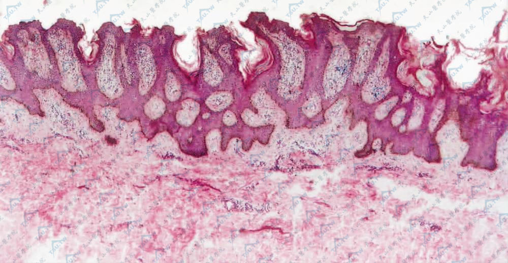 表皮角化过度，乳头瘤样增生，乳头间凹陷处棘层肥厚，乳头顶部及两侧表皮变薄