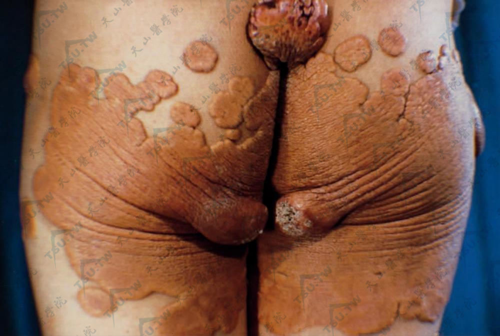 弥漫性扁平黄瘤：臀部见扁平隆起境界清楚的红斑、褐黄或橘黄色斑块