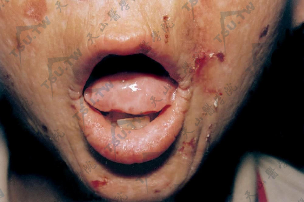 类脂蛋白沉积症：唇、舌黄白色浸润，不能伸出口外