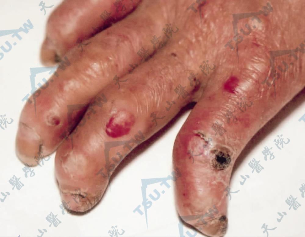 手指上可见数个黄豆大的血疮，手指变短，指端毁形，多个指间关节僵硬变形