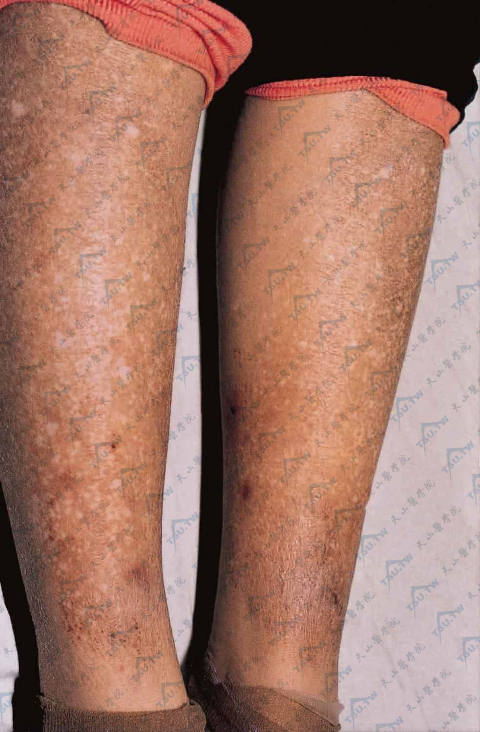 淀粉样变病（下肢、异色病样）两下肢见多数针头大丘疹，有色素沉着及减退，呈皮肤异色病样改变
