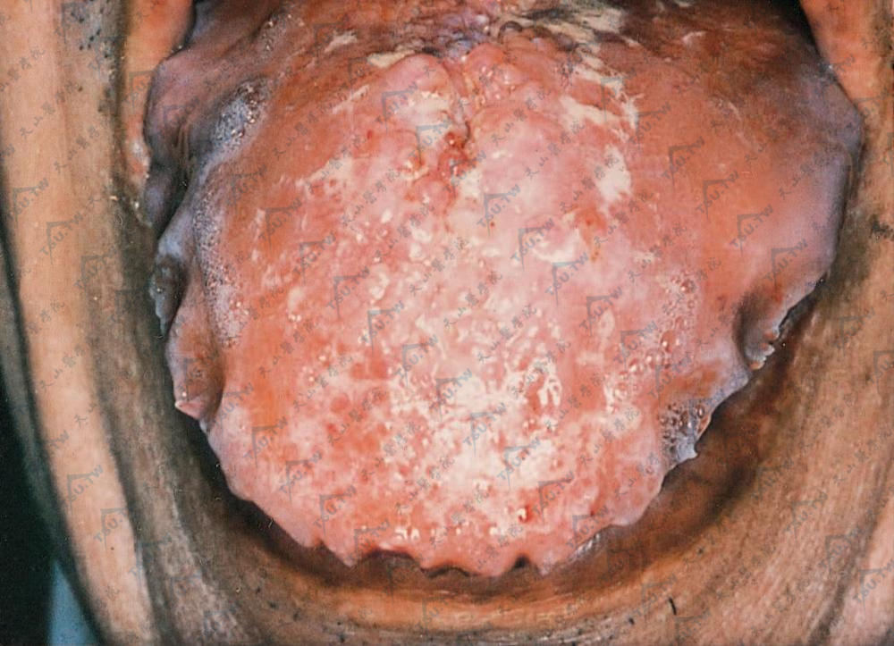 舌淀粉样变，弥漫浸润，显示巨舌，见明显齿痕，舌面有丘疹、结节、糜烂、脓性分泌物
