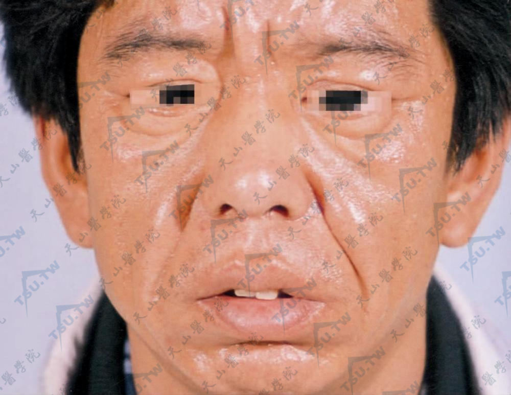 硬化性黏液水肿面部皮肤呈弥漫性浸润增厚，尤其在额部明显，眉间、鼻根部皮肤凸出肥厚