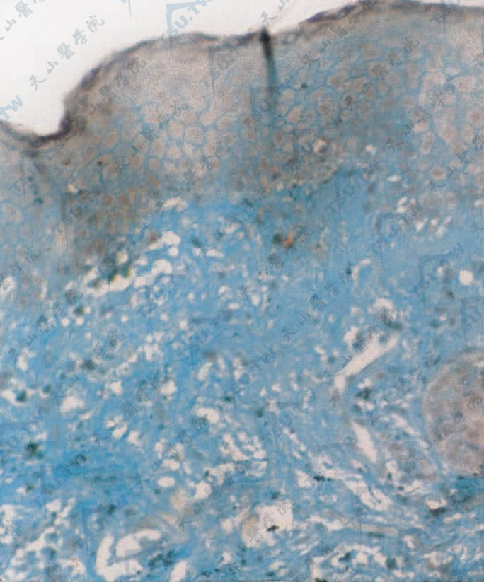 网状红斑性黏蛋白病真皮浅层胶原束间可见淡蓝色物质沉积