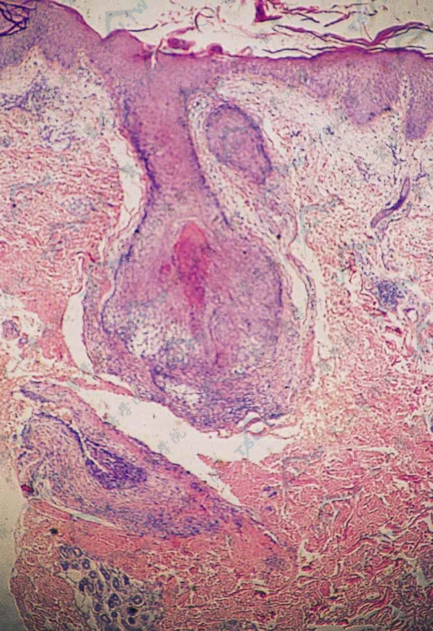 真皮中层毛囊及细胞水肿，外毛根鞘上皮及毛囊周围见黏液样物质