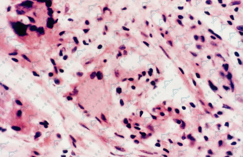 真皮内散在肉芽肿性病变，有郎罕巨细胞（HE染色×400）