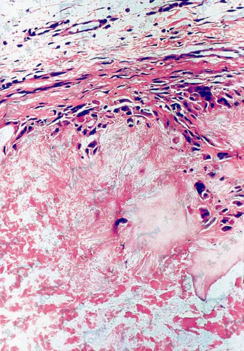 痛风组织病理可见皮下境界清楚的展酸盆结晶紧压成束（HE染色×200）