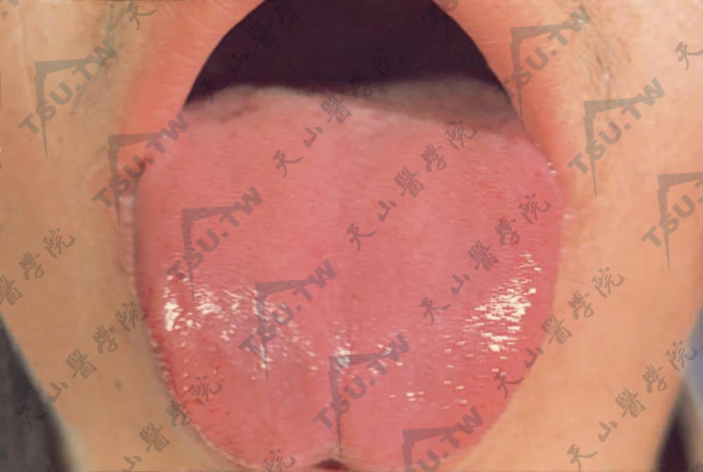 舌面呈紫红色，舌乳头初期肥大，久后变平萎缩，舌平滑