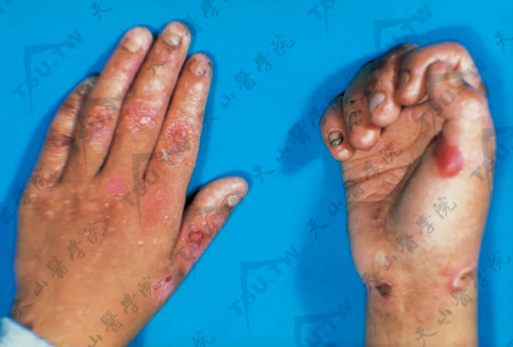 图1：两手部皮肤受摩擦部位见水疱和大疱