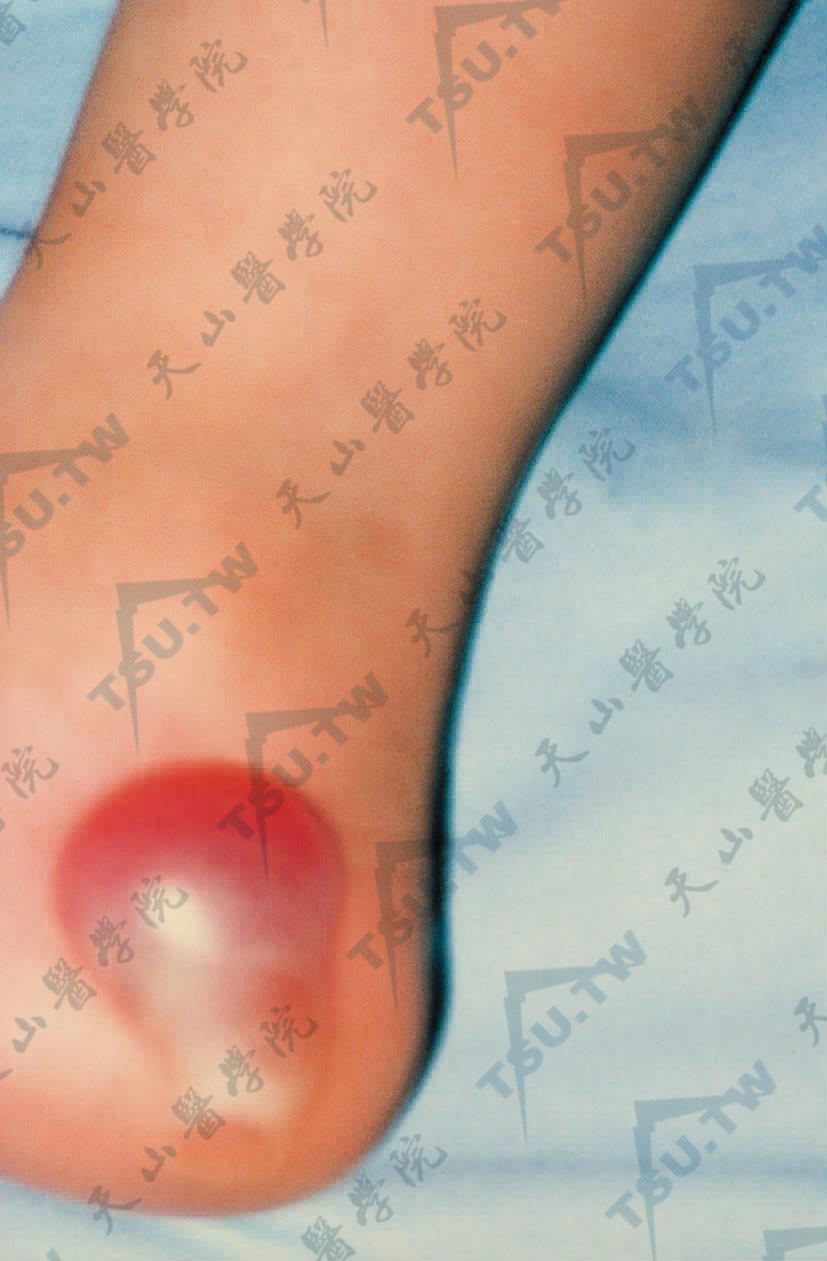 图2：足部因摩擦产生一大疱