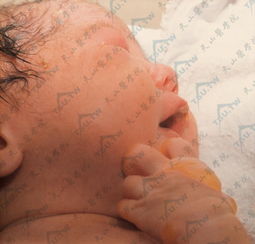 图3：婴儿出生时口周、唇部大疱