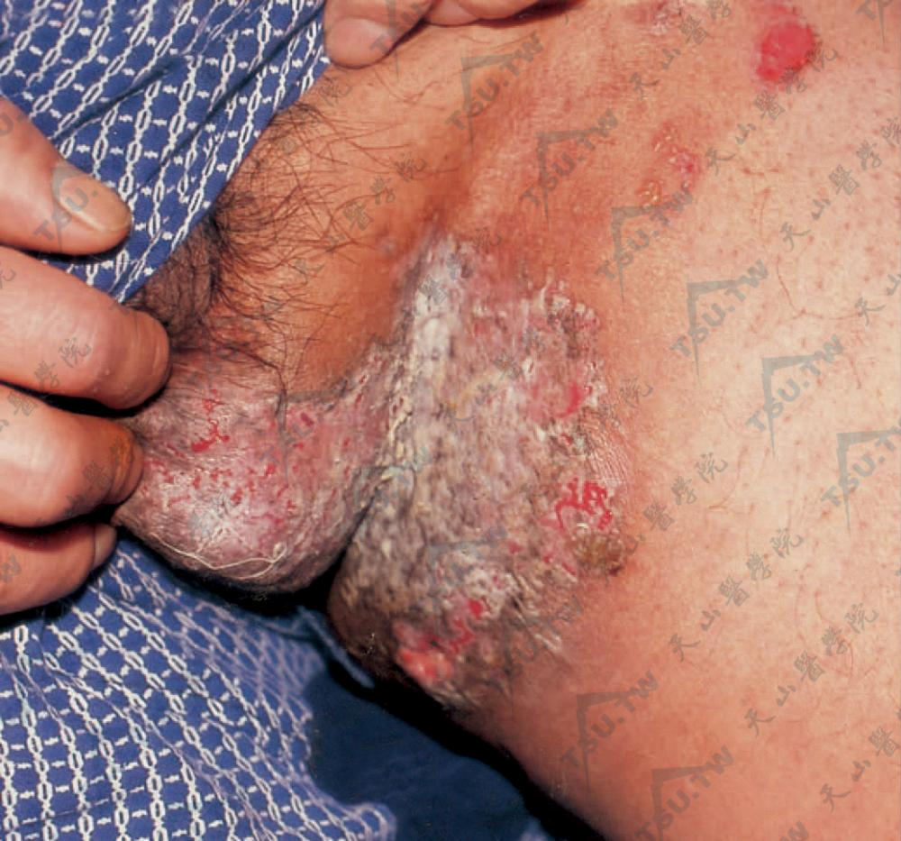 家族性良性慢性天疱疮症状：阴股部见红斑、糜烂、结痂，呈湿润增殖面