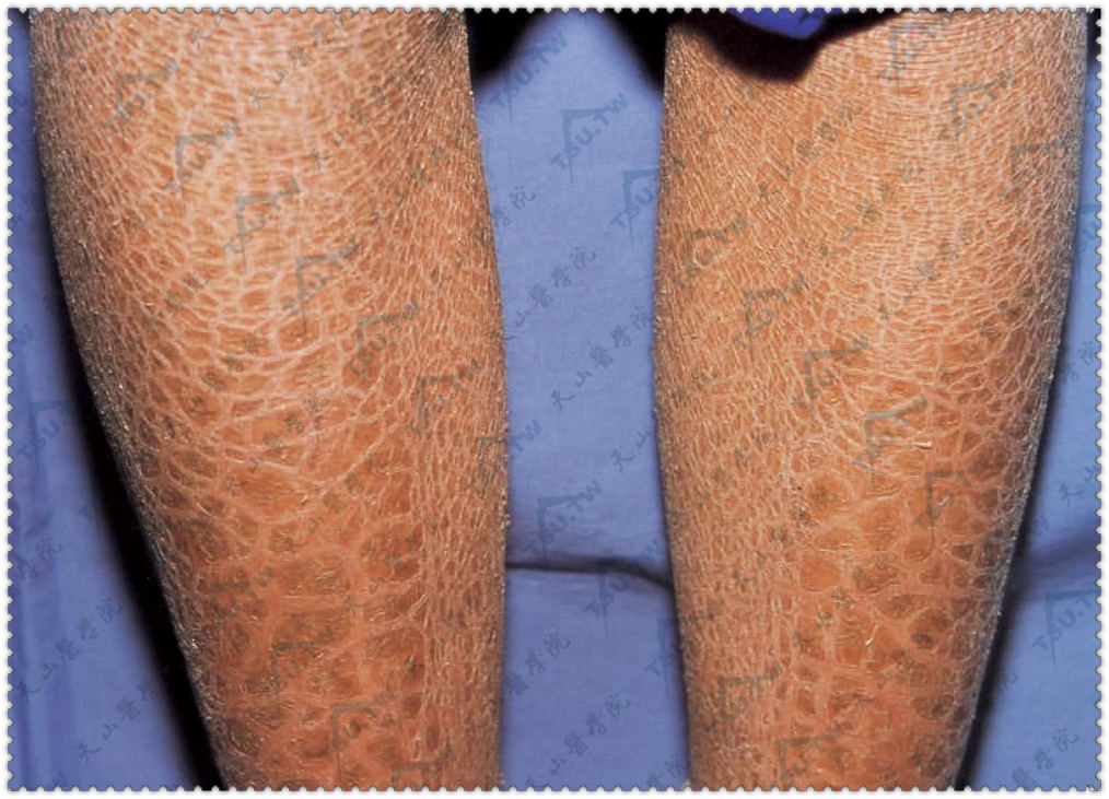 寻常型鱼鳞病（干皮病）症状：四肢伸侧皮肤干燥，出现淡褐至深褐色菱形网状、多角形鳞屑，紧贴于皮肤，而其边缘则呈游离状