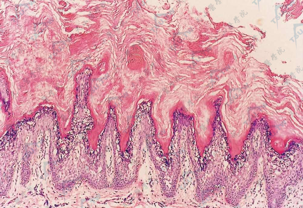 表皮松解性角化过度症的皮肤组织病理学改变