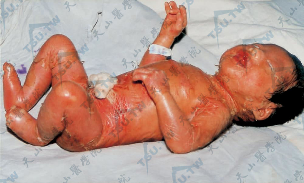 胶样婴儿：婴儿全身被紧束的羊皮纸样或胶膜样表皮所覆盖