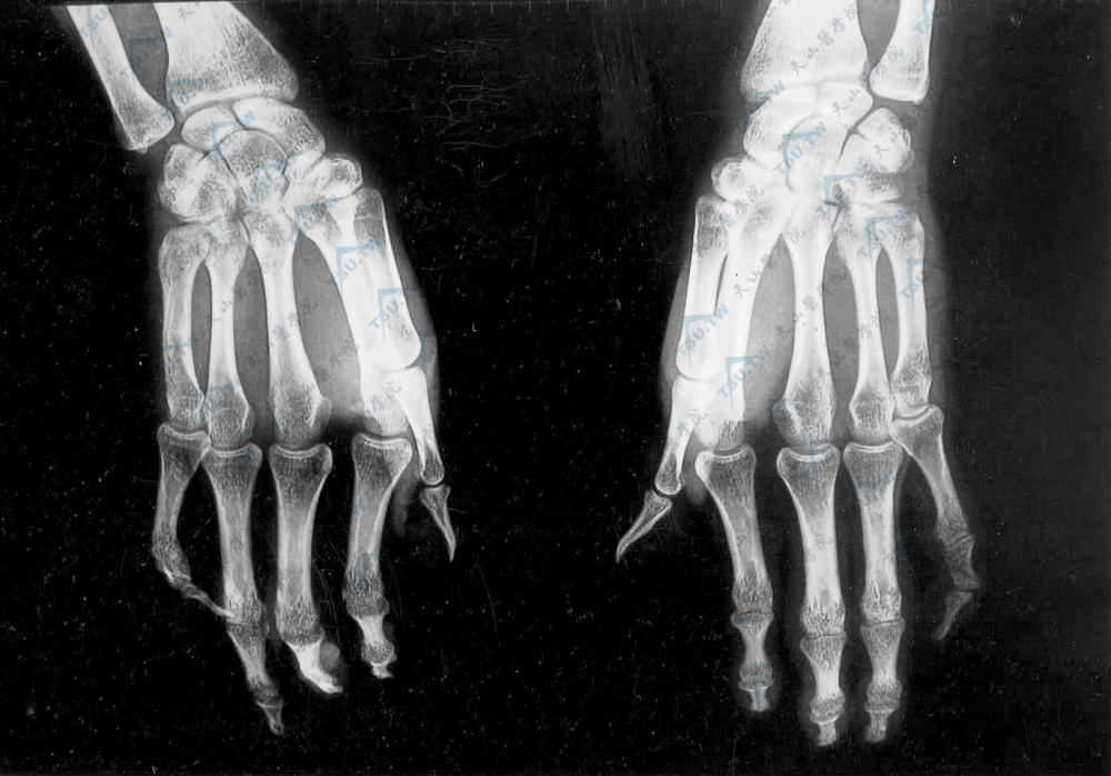 有汗性外胚叶发育不良：手部X线影像图示双手拇指呈内收状，2～5指屈曲，各指末节指骨较细，2～5指各指间关节间隙变窄