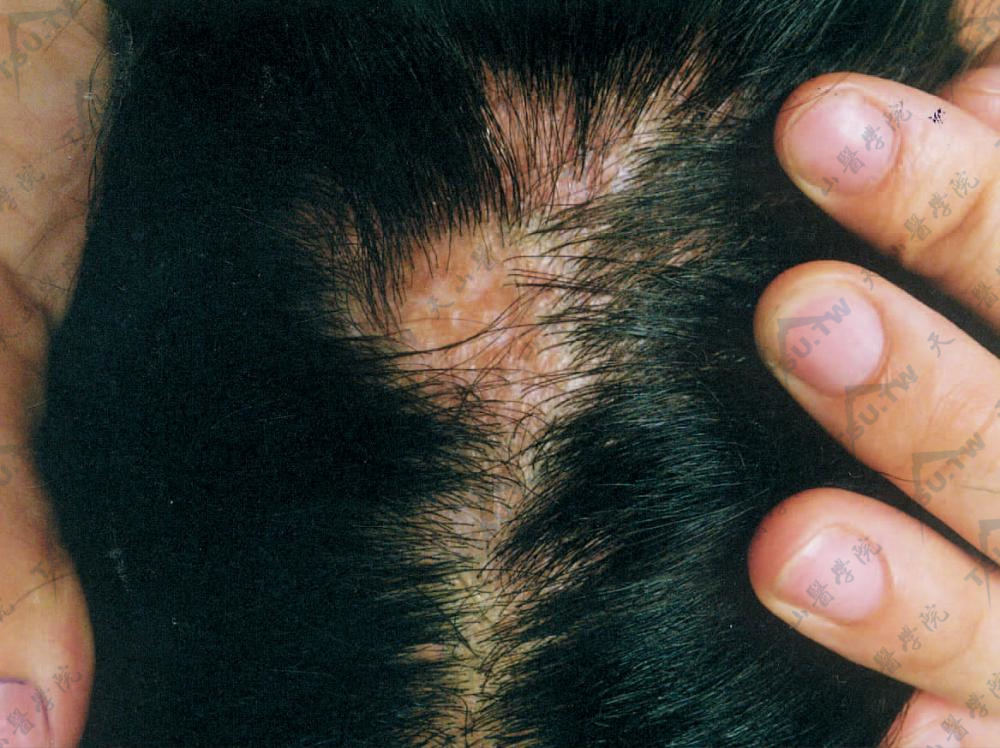 拉普-霍奇金外胚叶发育不良综合征：头顶部斑块状脱发