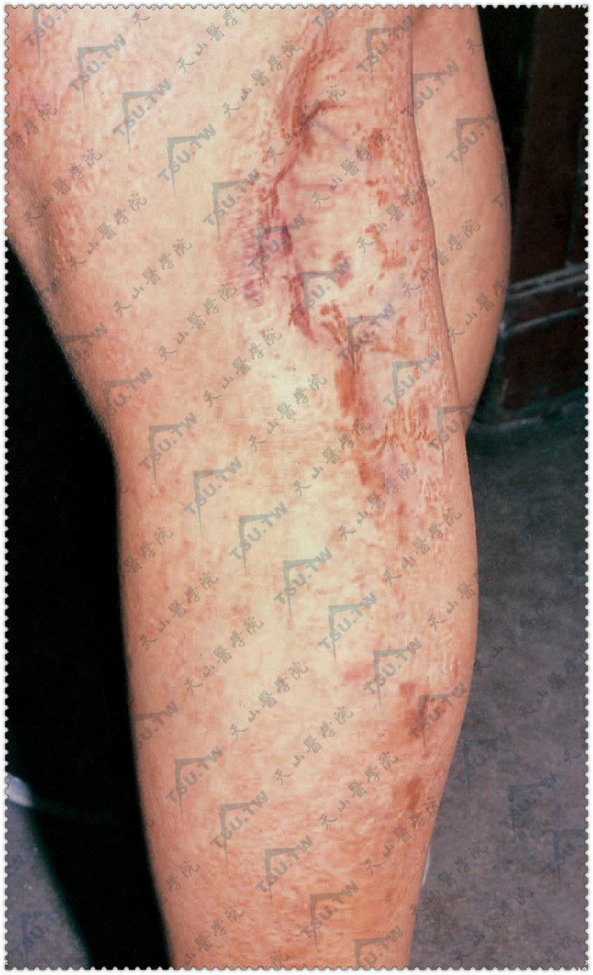 局灶性真皮发育不良：下肢局灶性皮肤变薄，境界清楚，表皮凹陷，见线状红褐色斑