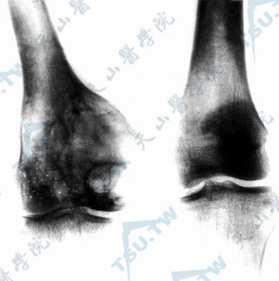 X线检查见骨骺端呈现条纹状改变