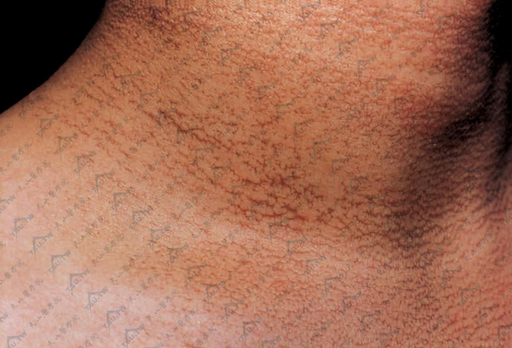 先天性角化不良颈部条纹或网状色素沉着斑：深颜色条纹皮肤