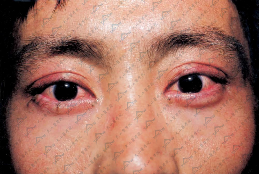 先天性角化不良：双眼结膜充血，毛细血管扩张