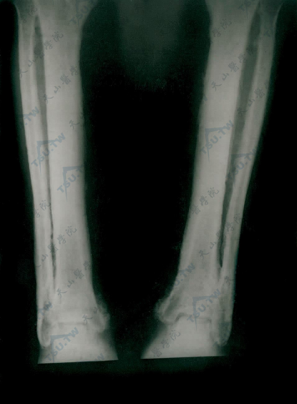 双下肢X线片示胫腓骨骨膜骨化增厚，骨皮质增厚