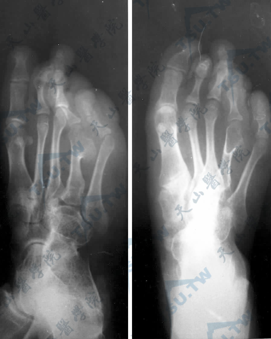 X线图像示右足多发性骨软骨瘤，第3趾巨趾畸形