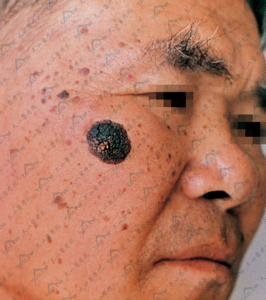 脂溢性角化病（老年疣）发生于面部的症状