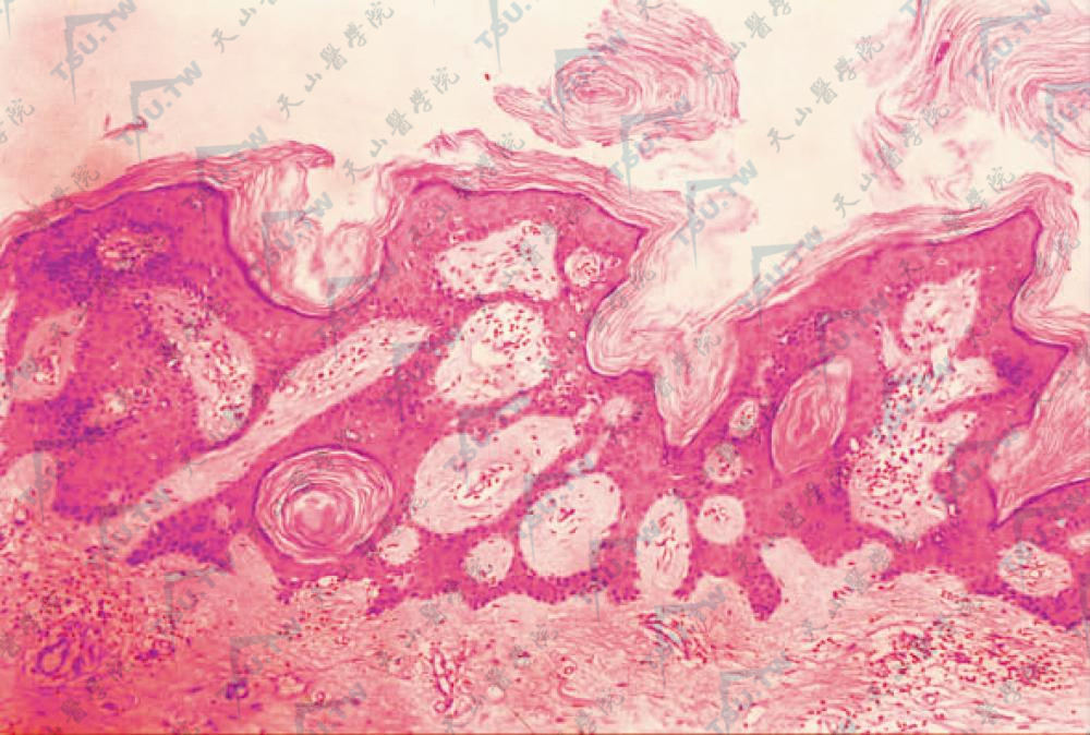 脂溢性角化病（老年疣）组织病理学改变