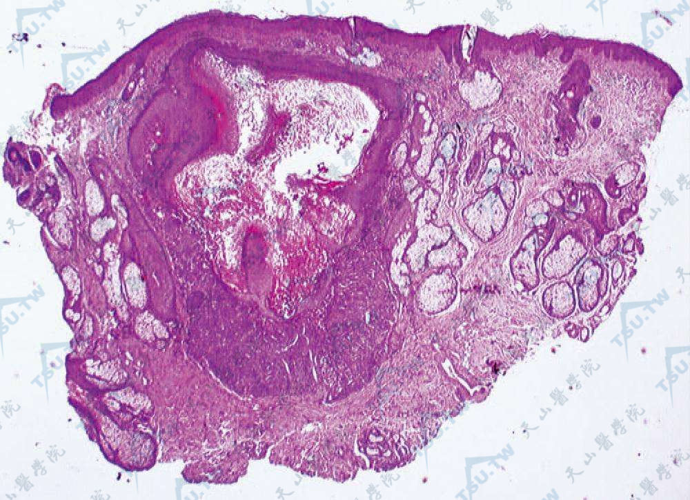 疣状角化不良瘤组织病理学改变