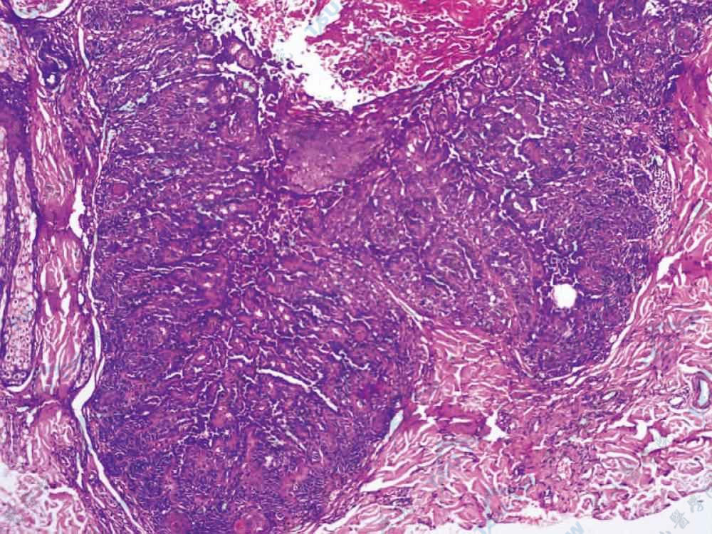 疣状角化不良瘤组织病理学改变