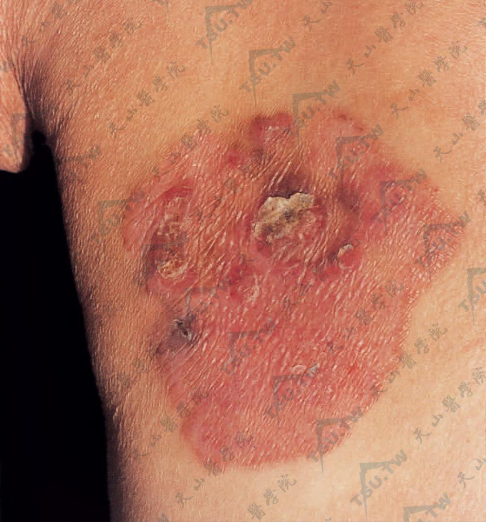 鲍恩病的症状：为境界清楚的红斑，表面湿润、潮红、结痂，边缘略隆起