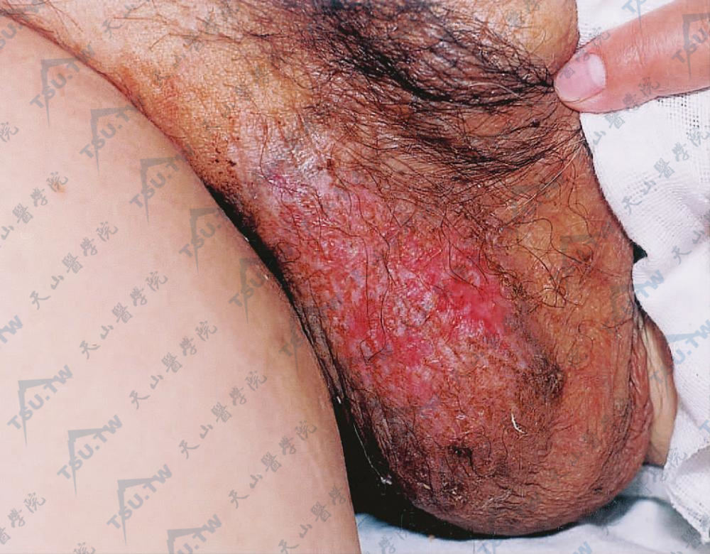 右侧阴囊5cm×6cm浸润性红斑，表面有轻度糜烂、渗液和结痂