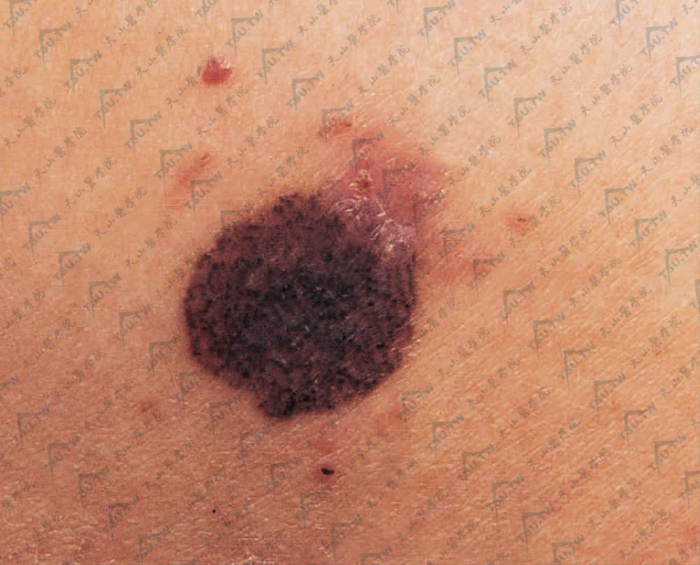 基底细胞癌症状：为红色稍隆起的斑片，上有增生性小黑点，表面角化