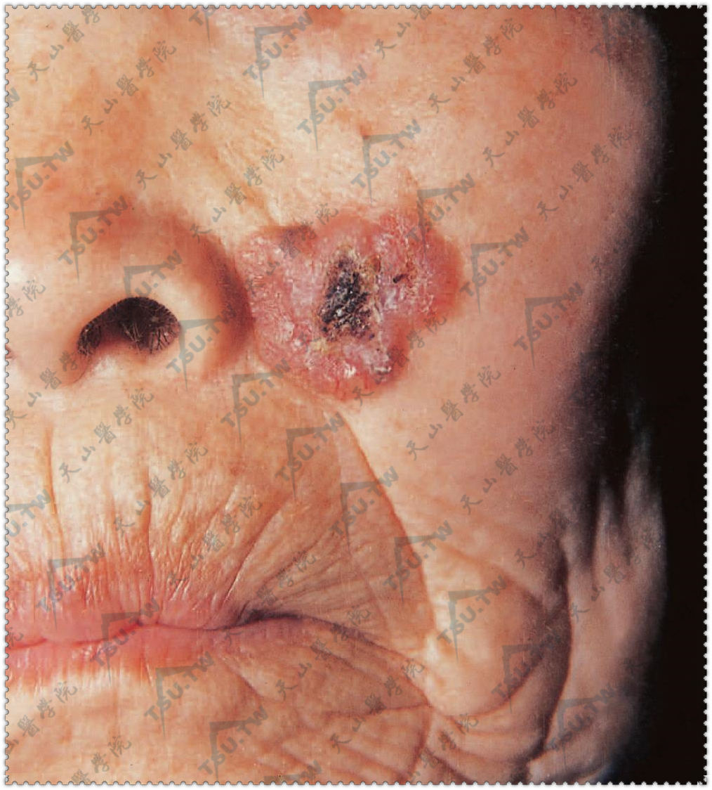 基底细胞癌患者面部症状：缓慢扩大的溃疡，周围绕以珍珠样隆起的边缘，中心有结痂。有浸润