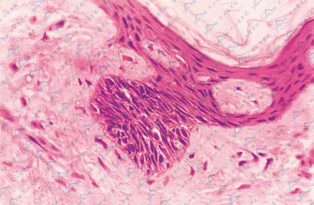 基底细胞癌组织病理学改变：瘤细胞团块深染附着于表皮基底部（HE染色×100）