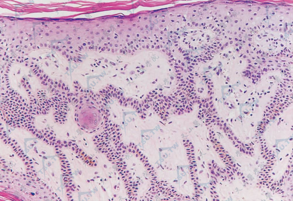 基底细胞呈条索状向真皮延伸，条索多数由2层细胞组成，胞核大，嗜碱性，胞质淡染