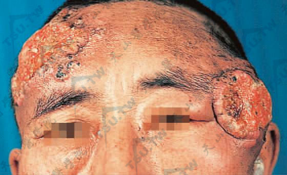 皮肤癌早期治疗图片