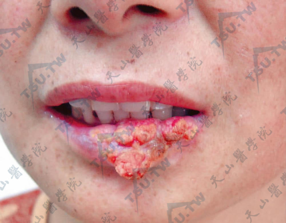 鳞状细胞癌症状：唇部呈菜花状生长的肿状，溃破易出血
