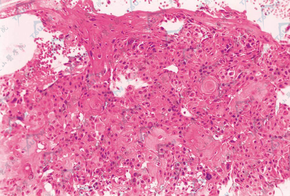 异形鳞状细胞，形态大小不一，间变，见多数角珠（HE染色×100）