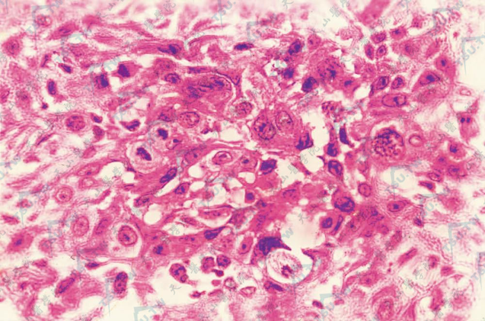 组织病理学改变：见异形鳞状细胞（HE染色×400）