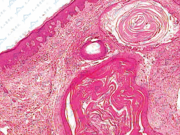 毛根鞘囊肿组织病理学改变