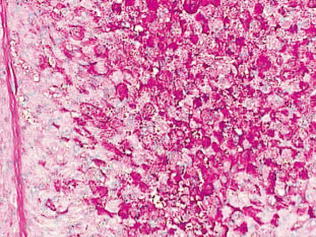 单发性外毛根鞘瘤组织病理学改变