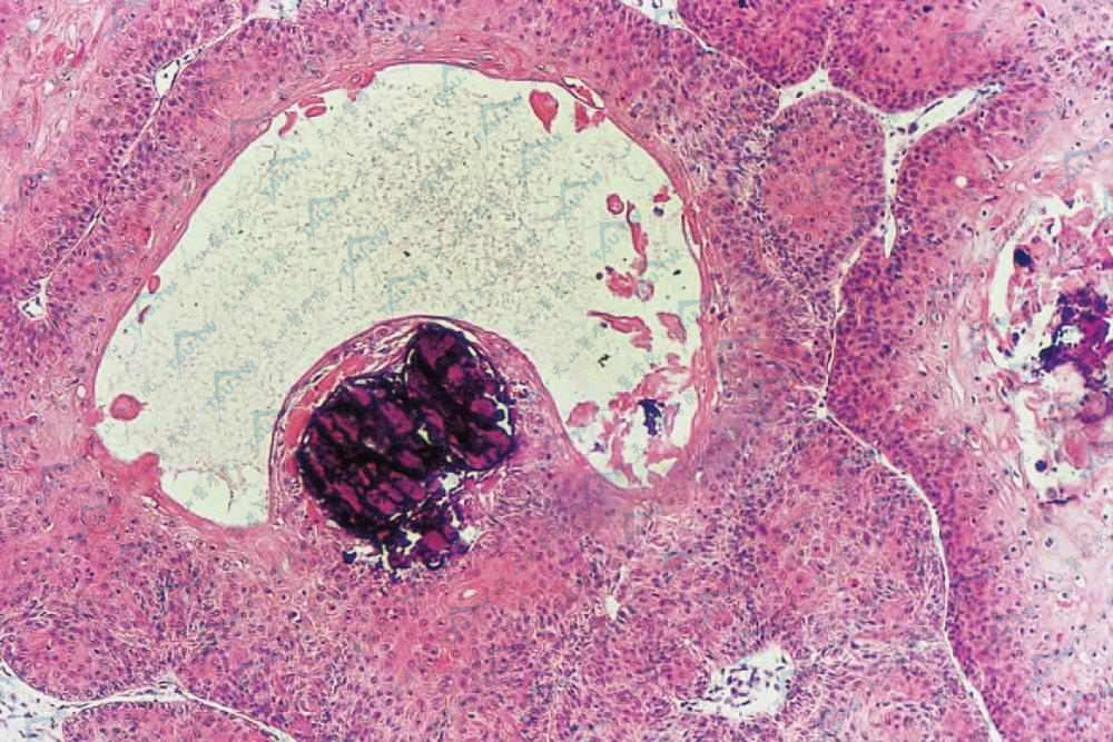 瘤组织内大囊腔见钙化灶（HE染色×400）