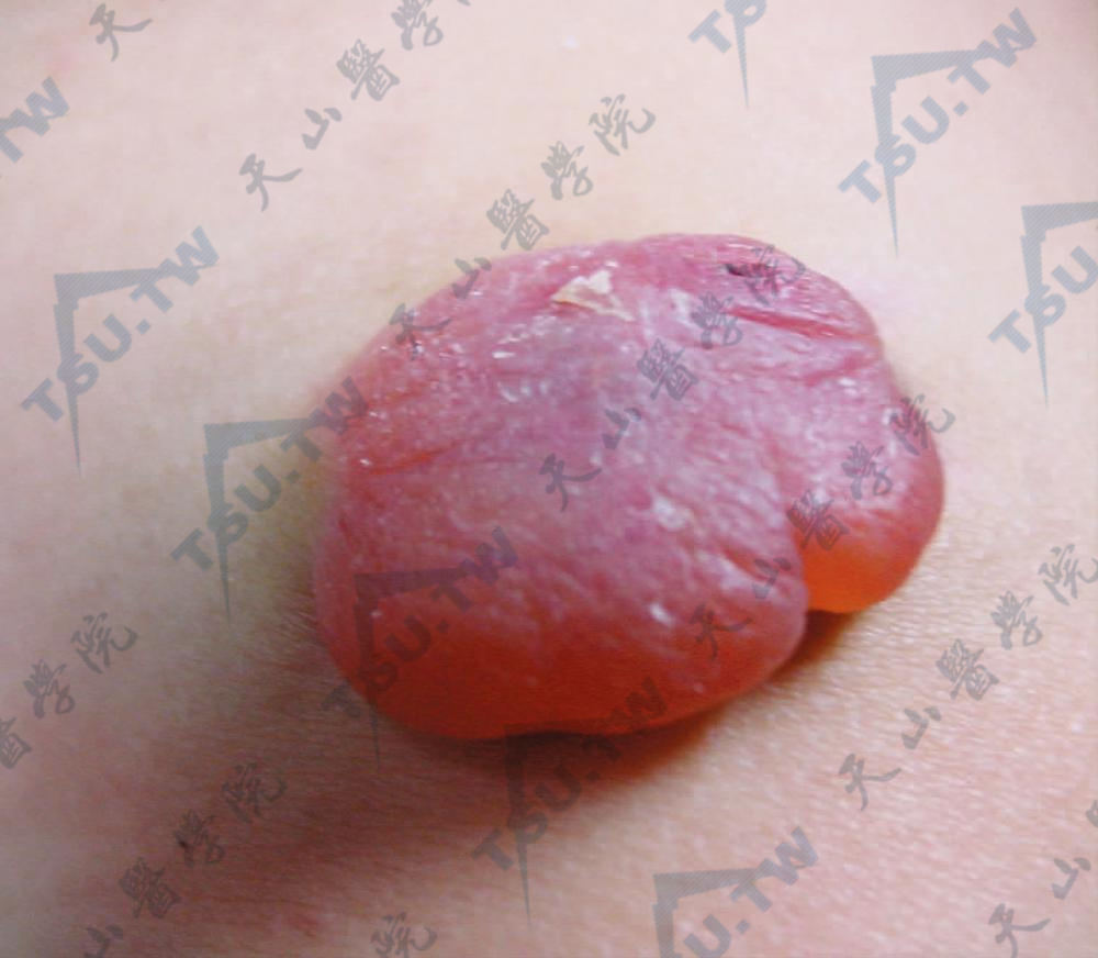 毛母质瘤（Pilomatrixoma）