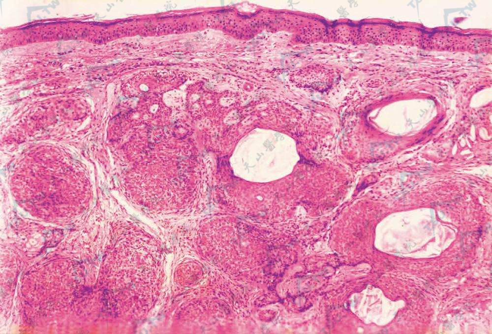 毛发上皮瘤组织病理学改变：真皮内基底样细胞团块及角囊肿（HE染色×100）